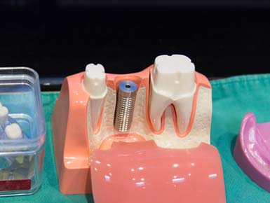 Implantate funktionieren genau wie gesunde Zähne informieren Sie sich.