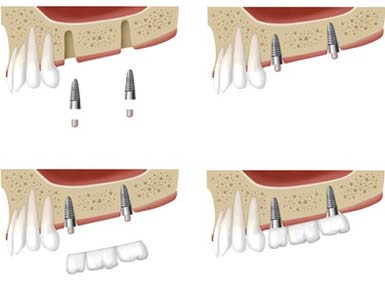 Implantate seit 30 Jahren bewährte Praxis auch bei Zahnarzt Paudler.