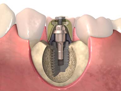Zähne / Implantate natürlichste Form des Gebisses bei Zahnarzt Paudler.